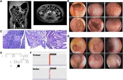 A Novel Variant of X-Linked Moesin Gene in a Boy With Inflammatory Bowel Disease Like Disease-A Case Report